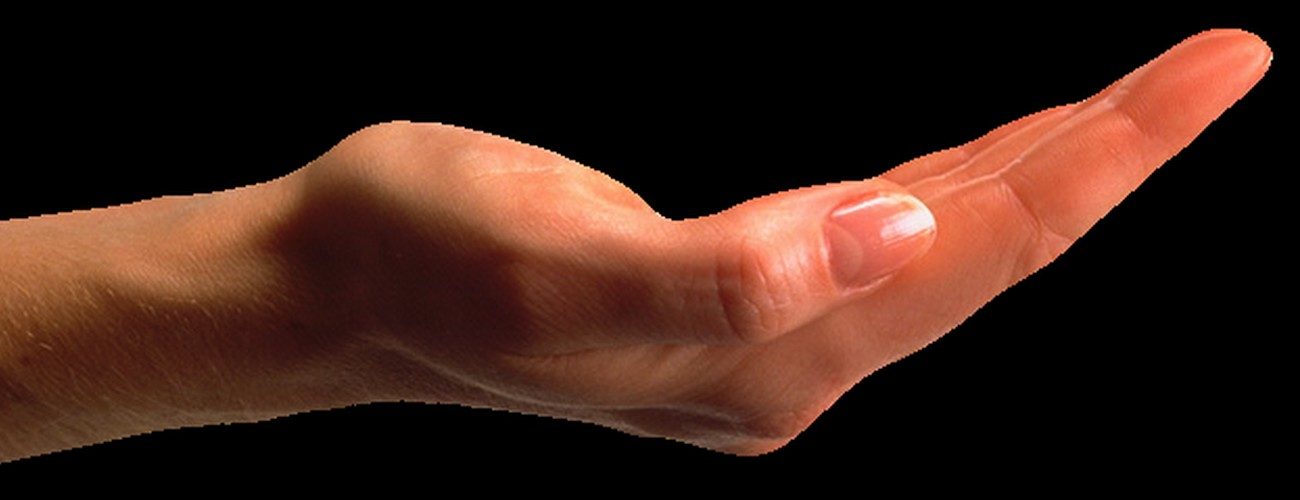 mendicite